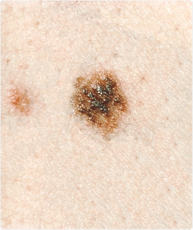 Dysplastic Nevi - This lesion has a dark brown, 'pebbly' elevated surface against a lighter tan, macular background. The irregular, indistinct margin of the nevus helps to distinguish it from the small congenital-pattern nevus, which some dysplastic nevi closely resemble clinically. Its distinctive morphology, not its size (6 by 6 mm), identifies it as a dysplastic nevus. Image Credit: visualsonline.cancer.gov
